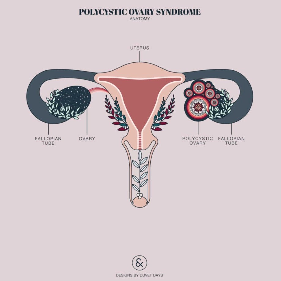 I have Polycystic Ovarian Syndrome... and I'm no longer being ...